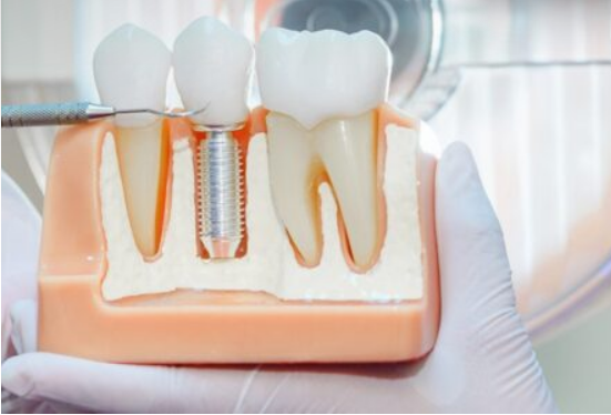 протезування на імплантах